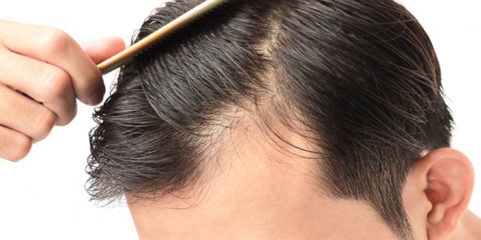 چگونه از ریزش مو در مردان جلوگیری کنیم