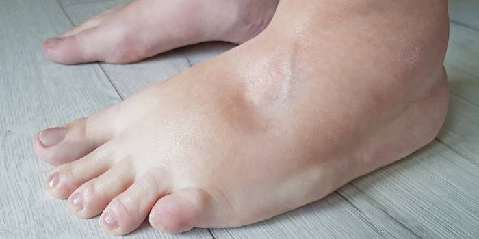 ترومبوز ورید عمقی (DVT)